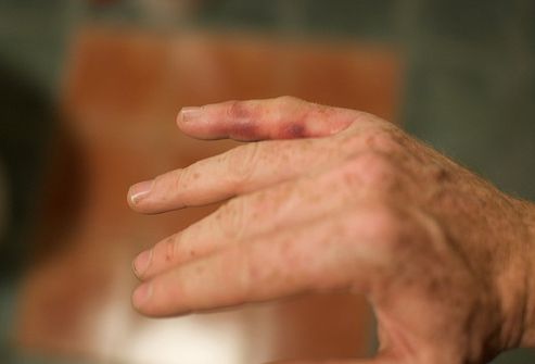 Dolore alle articolazioni delle mani