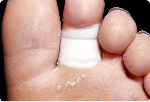 Cause di frattura delle dita dei piedi