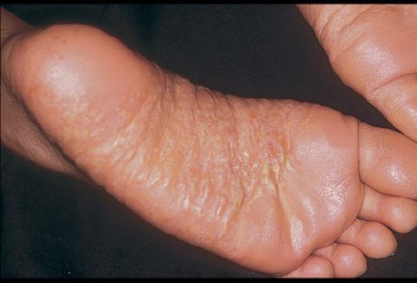 Dermatite delle gambe e delle sue cause