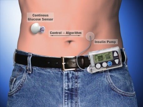 diabete pancreas artificiale