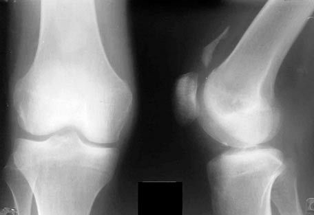 Roentgen dell'articolazione del ginocchio