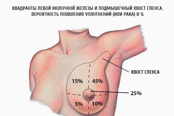 I quadranti del seno sinistro e la spoglia ascellare dello spence.  La probabilità di sigilli (o cancro) in%