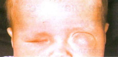 Microftalmo con concomitante formazione di cisti (occhio sinistro).  Anoftalmo (occhio destro).