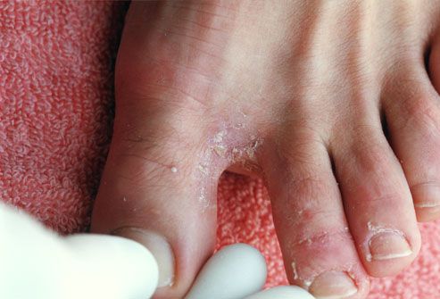 Epidermophytia del piede