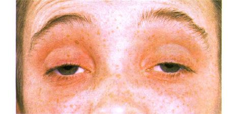Oftalmoplegia esterna.  Ptosi bilaterale.  Il paziente apre gli occhi sollevando le sopracciglia