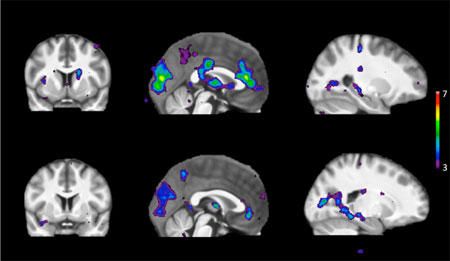 La scansione mostra aree dell'attività cerebrale in risposta a stimoli in persone con un metabolismo veloce della nicotina (riga superiore) e un lento metabolismo della nicotina (riga inferiore)