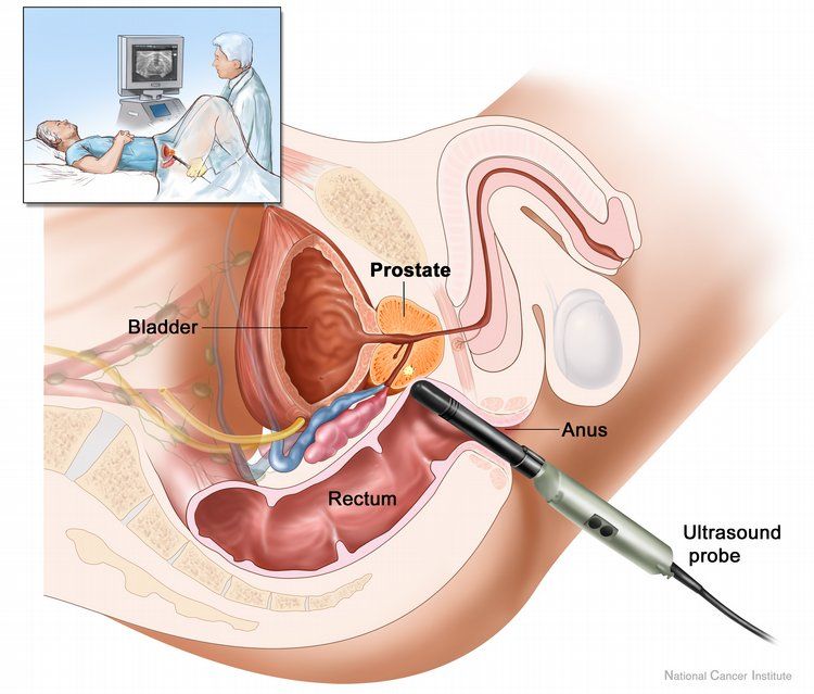 È stato creato un farmaco efficace contro il cancro alla prostata a base di tè e oro