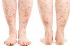 Macchie rosse sulle gambe: cause, diagnosi, trattamento ...