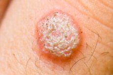 il papilloma virus porta prurito cancer colon maligne
