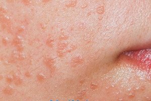throat cancer from human papillomavirus comprimat antiparazitar cu spectru larg