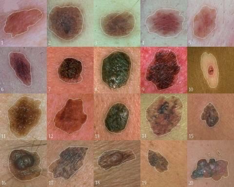 Gli scienziati hanno trovato un gene che svolge un ruolo centrale nello sviluppo del melanoma