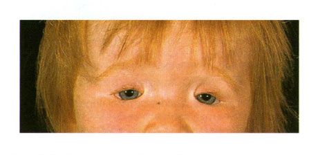 Coloboma bilaterale delle palpebre in un bambino con sindrome di Golden.  Chiusura della fessura dell'occhio a sinistra